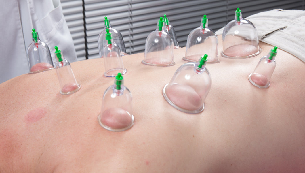 http---o.aolcdn.com-hss-storage-midas-8833f82d0bc6b8004d6e36bf63f8916f-204184101-stock-photo-acupuncture-fire-cupping-detail-on-man-s-back-285433880
